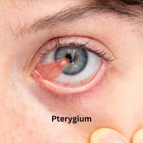 Corneal Diseases